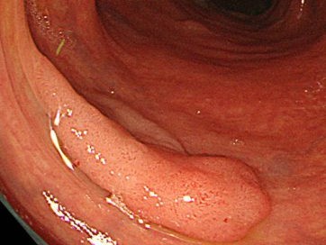 大腸の腺腫の通常観察