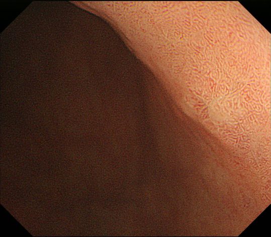 NBI併用拡大内視鏡