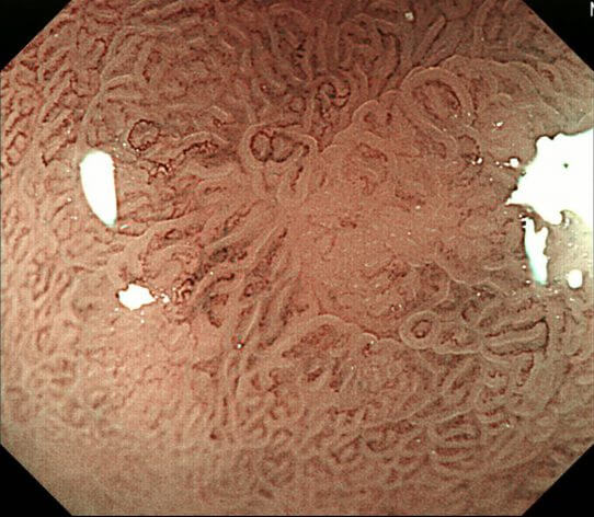 3mmの早期胃がんの写真