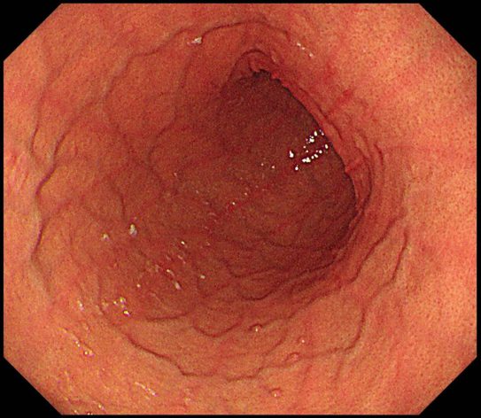 十分にひだが伸展している胃