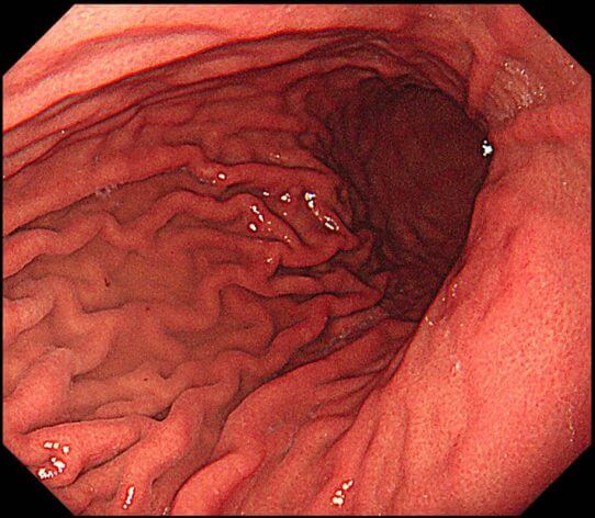 ひだが十分に伸展していない胃