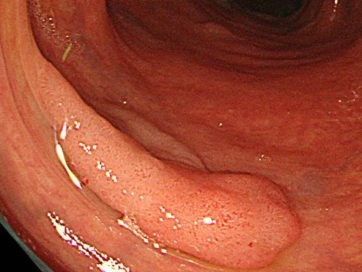 大腸の腺腫の通常観察